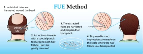 An illustration of the FUE hair transplant method