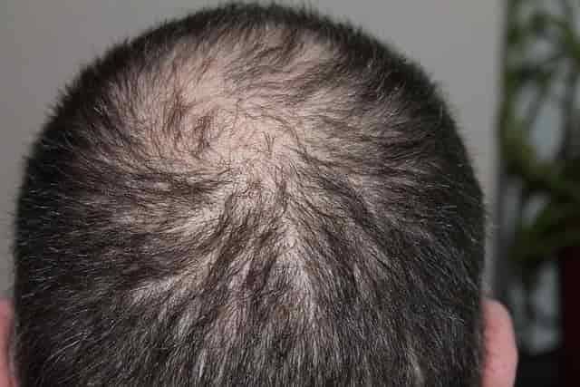 A scalp with hair loss in the vertex (crown)