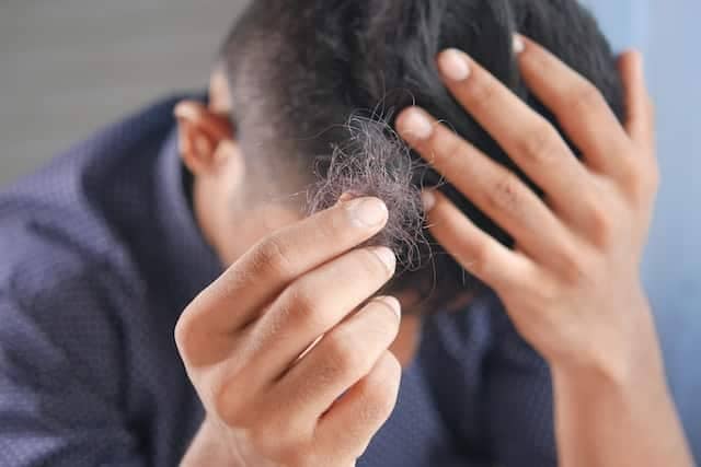 A person holding hair in hand due to male pattern baldness 
