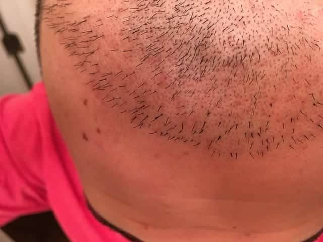 A head with hair growth after a hair transplant 