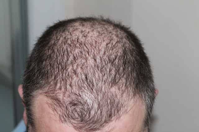 A scalp with hair loss in the frontal region